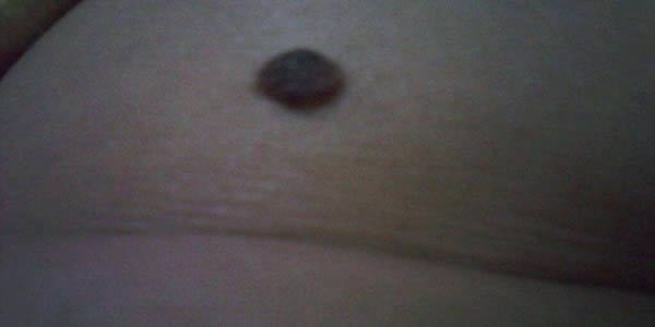 女人胸上有痣代表什么？女人胸部7位置痣的含义解读