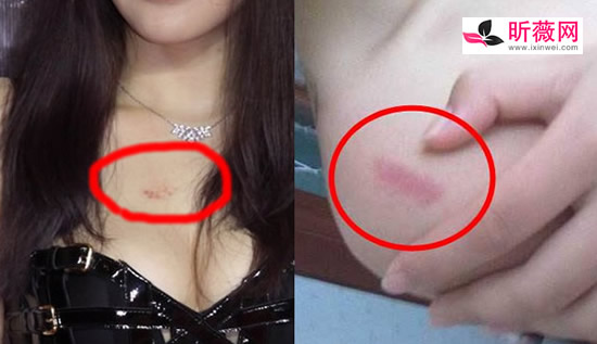 草莓印多久才能消失 一小时快速消除草莓印吻痕