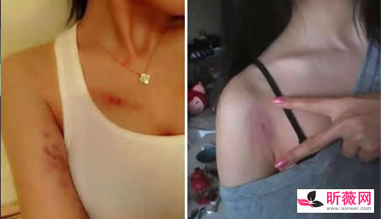 草莓印多久才能消失 一小时快速消除草莓印吻痕