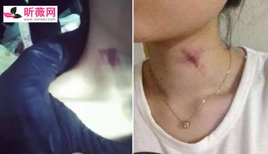 草莓印多久能消失 脖子上的草莓印怎么快速消除