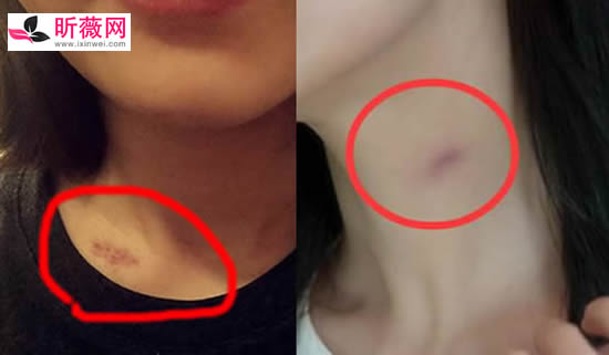 草莓印多久能消失 脖子上的草莓印怎么快速消除