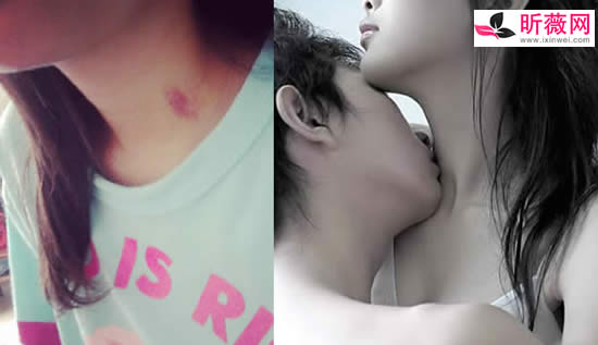 草莓印多久能消失 脖子上的草莓印怎么快速消除