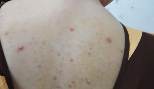 背上长痘痘什么原因导致的 不可忽视的长痘痘原因 背上长痘痘什么原因导致的 不可忽视的长痘痘原因