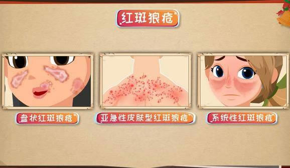 红斑狼疮